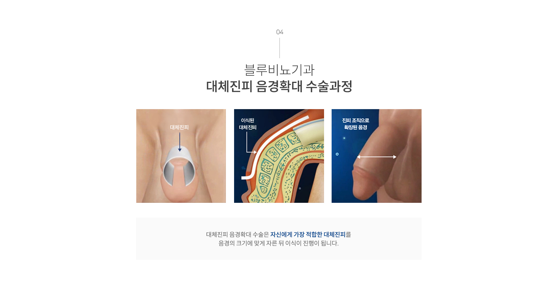 남성수술 이미지5